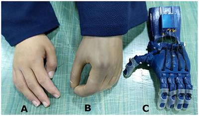 Suitability of the Openly Accessible 3D Printed Prosthetic Hands for War-Wounded Children